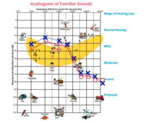 The Basics Of An Audiogram - Whisper Audiology Hearing Clinic | Stoney ...